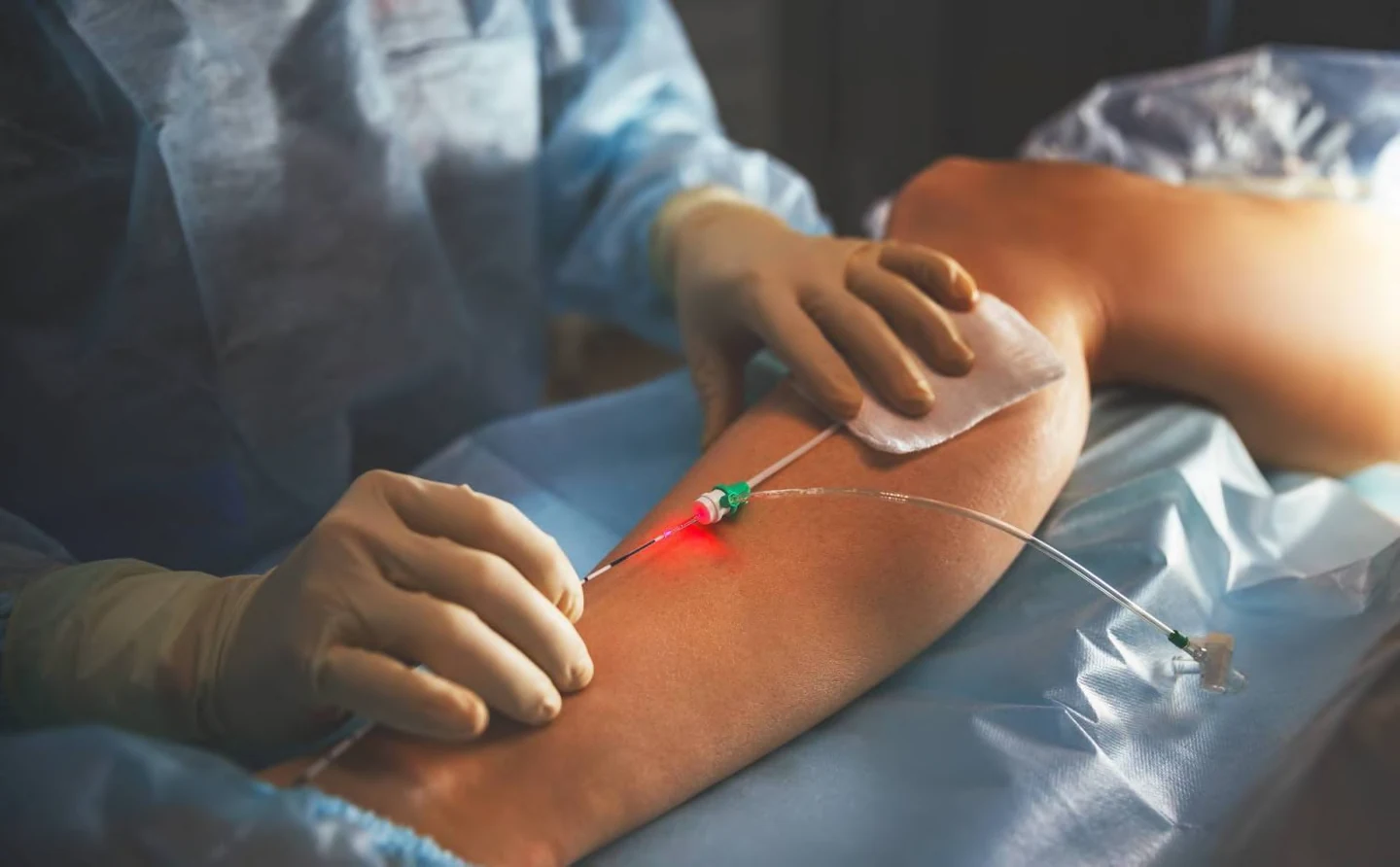 Procédure de laser endoveineux pour varices à Tanger
