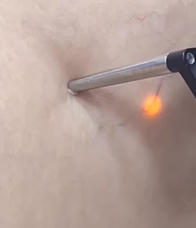 Laser vasculaire CYNOSURE Élite Plus à Tanger